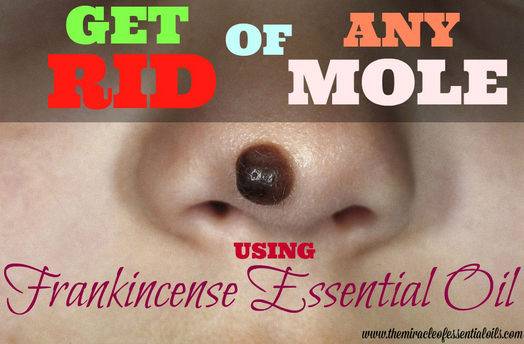 How to Use Frankincense to Remove Moles | Essential Oil Remedy that Works