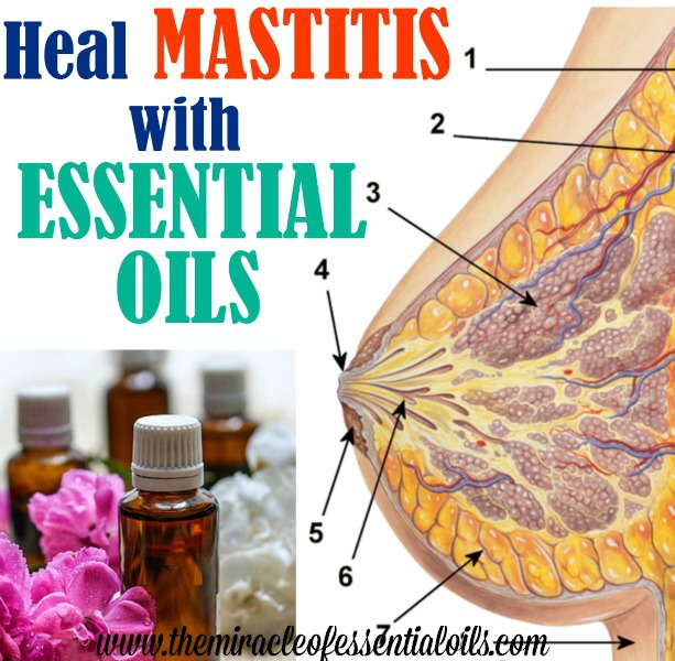 What are the Best Essential Oils for Mastitis?