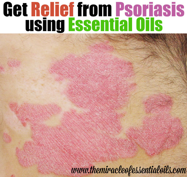 essential oils to treat psoriasis