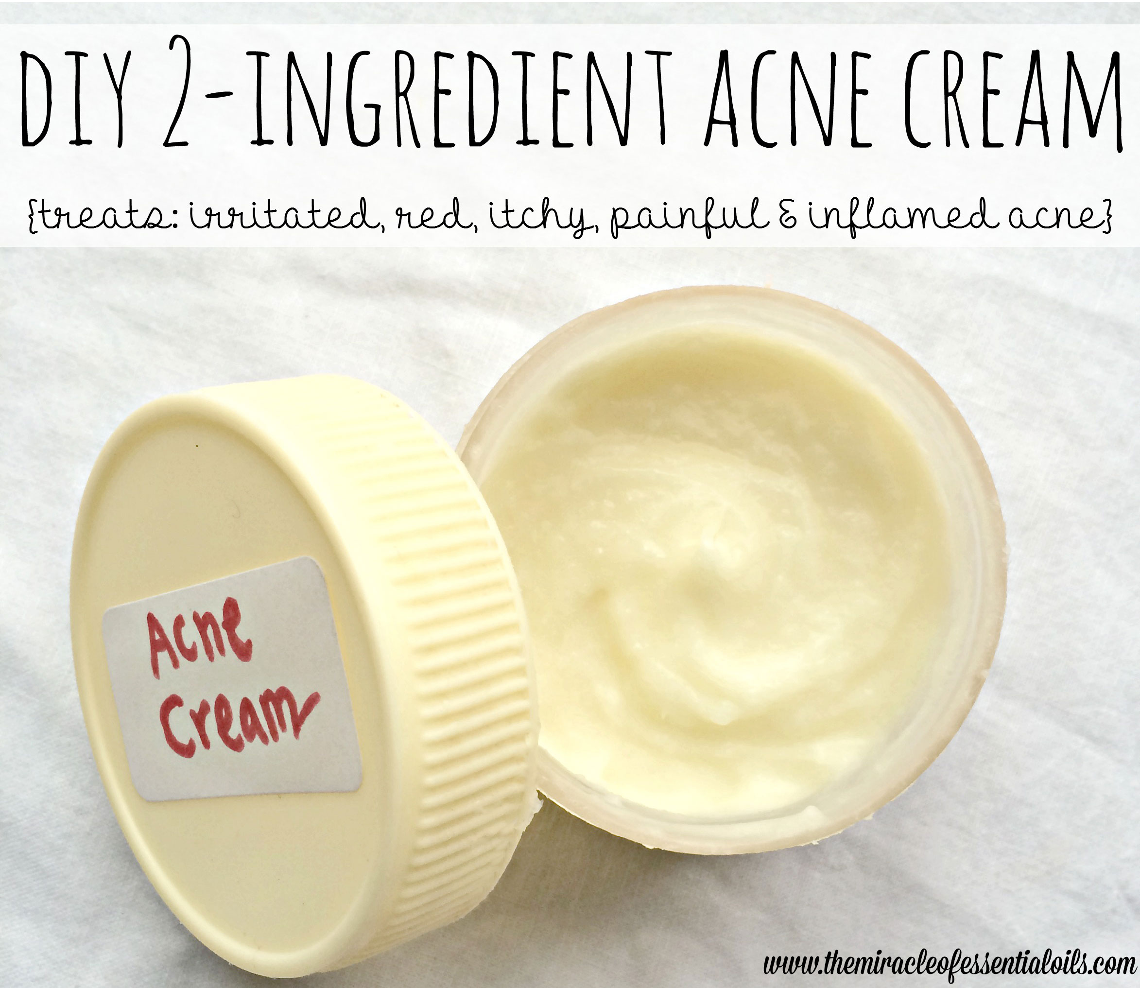 Homemade Cream for Acne with Tea Tree Oil | Only 2 Ingredients!
