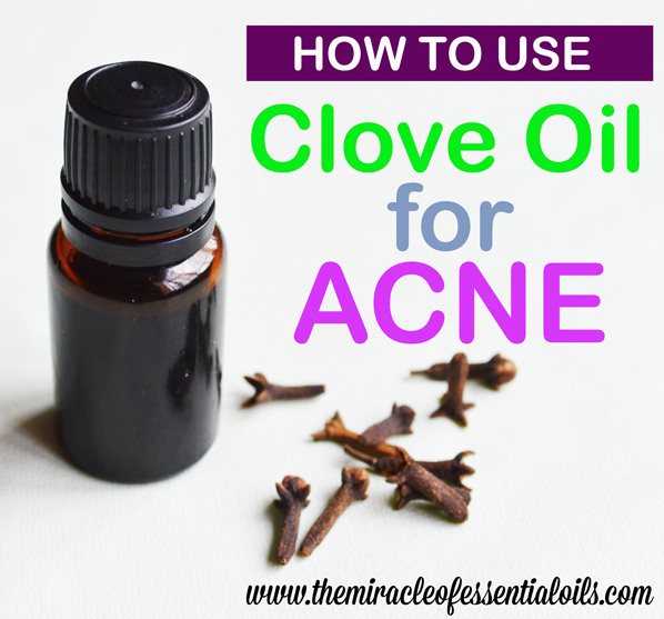 clove essential oil for acne