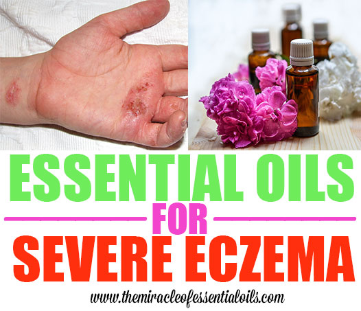 essential oils for severe eczema