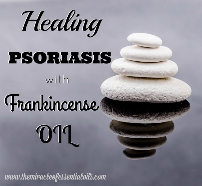 Frankincense Oil for Psoriasis | A Holistic Approach