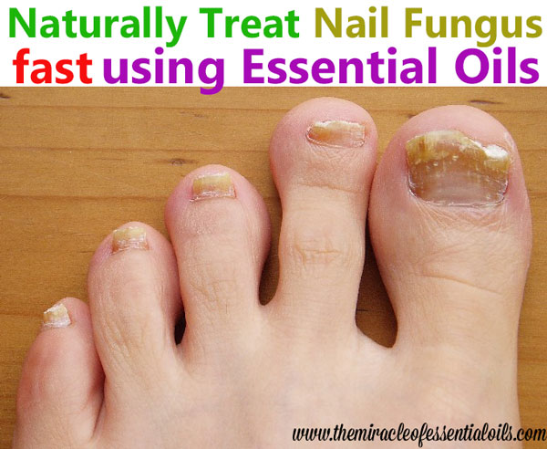 how to treat toe nail fungus with essential oils