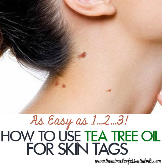 Tea Tree Oil for Skin Tags | Quick Natural Remedy