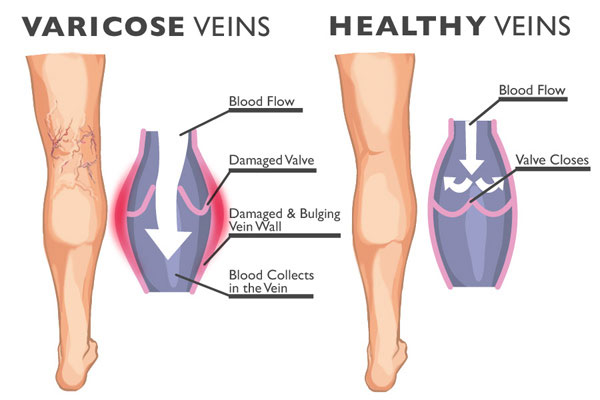 essential oils and varicose veins 