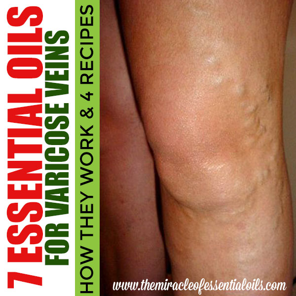 essential oils and varicose veins