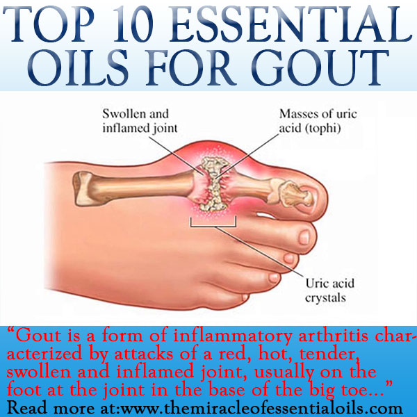 essential-oils-for-gout