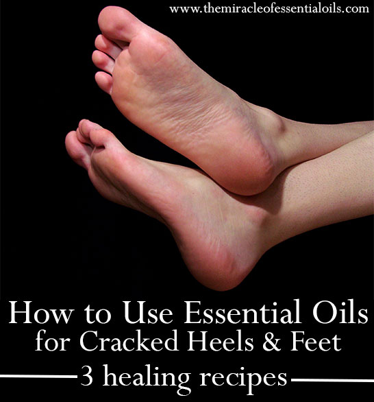 Home Remedies for Cracked Heels in Winter – MyCocoSoul