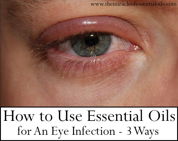 essential oils for eye infection