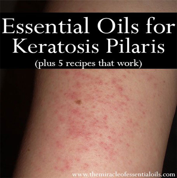 Check out these essential oils for keratosis pilaris to help naturally treat those weird bumps successfully!