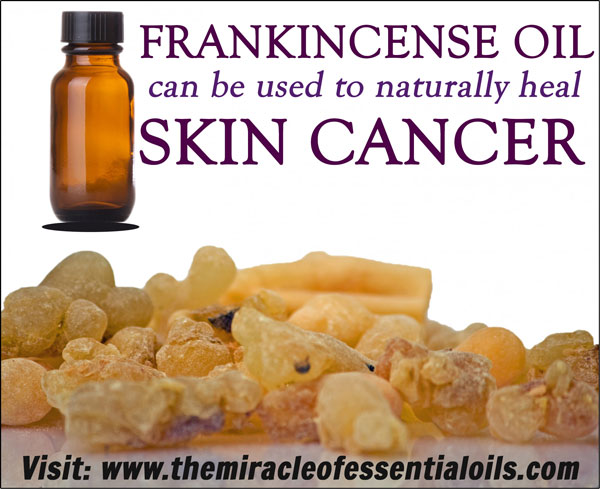 Frankincense Essential Oil for Skin Cancer Treatment