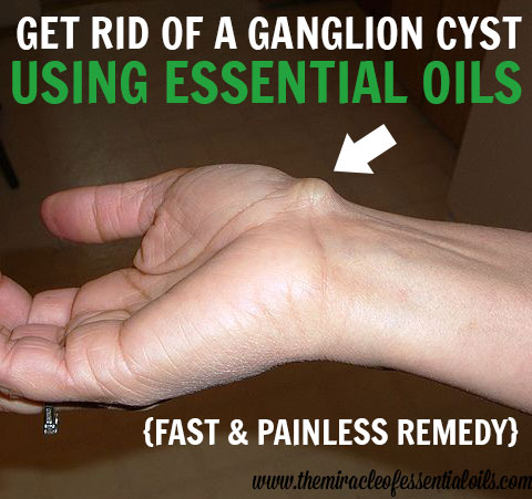 essential oils for ganglion cysts