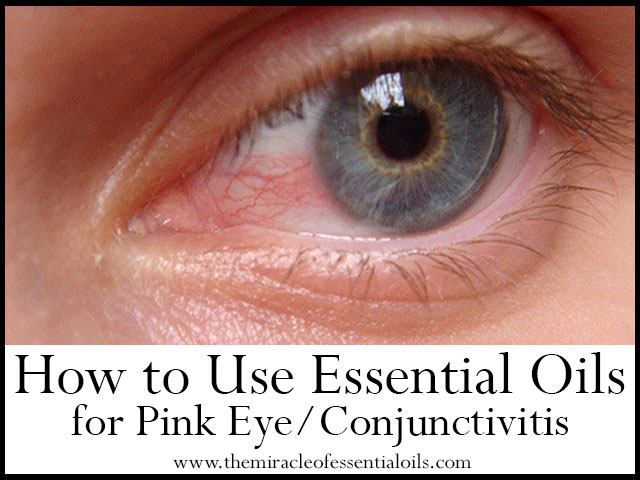 How to Use Essential Oils for Pink Eye or Conjunctivitis