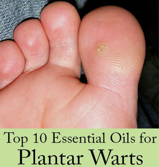 Find out the best essential oils to use for plantar warts and recipes that work