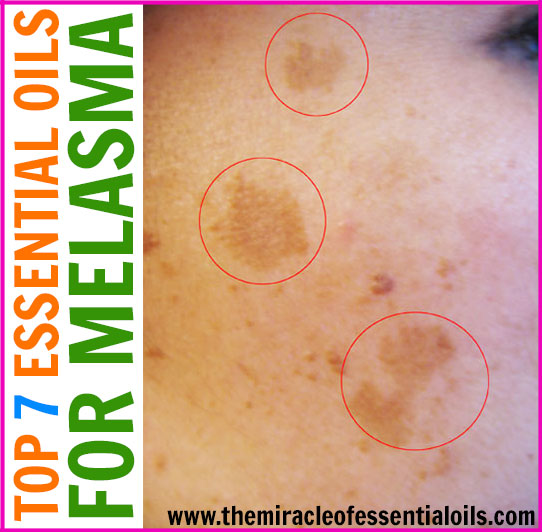 Plagued by dark spots on your skin, a.k.a melasma? Try naturally fading them away using these top essential oils for melasma! 