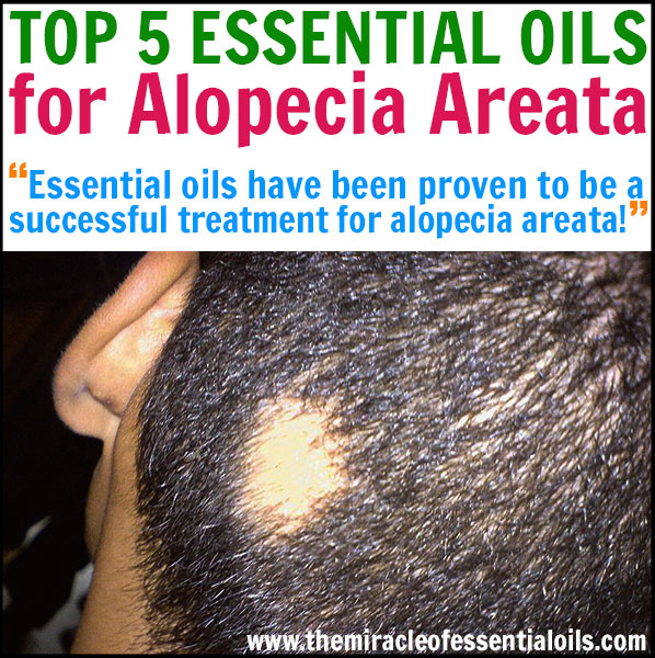 Top 7 Essential Oils for Alopecia Areata