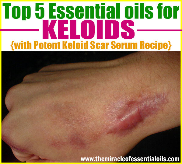 You can use essential oils for keloids in addition to conventional treatments and/or surgery to get back your flawless skin. 