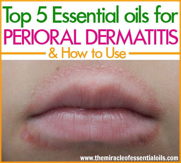 Natural remedies work very well in getting perioral dermatitis under control. Use one or more of these top 5 essential oils for perioral dermatitis as a quick natural remedy! 