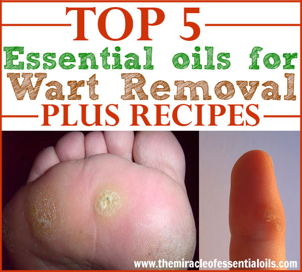 Top 5 Essential Oils for Wart Removal  & How to Use