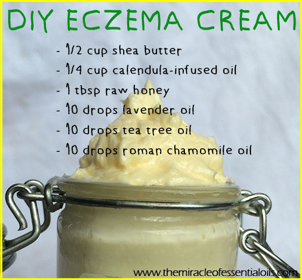 Check out this easy DIY essential oil eczema cream!