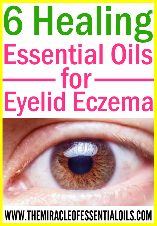 6 Essential Oils for Eczema on Eyelids (plus Healing Cream Recipe)