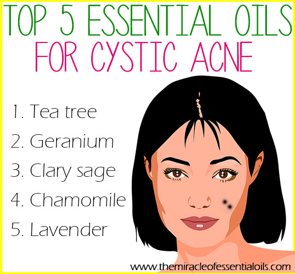 Use any of these 5 essential oils for cystic acne to get those cysts under control once and for all! 