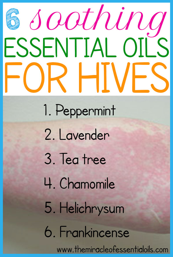 Use any of these 5 essential oils for hives to stop itching and heal that crazy rash fast! 